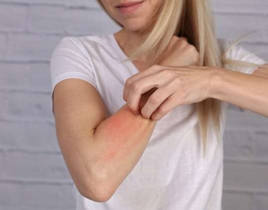 Psoriasis, remedios naturales para combatirla