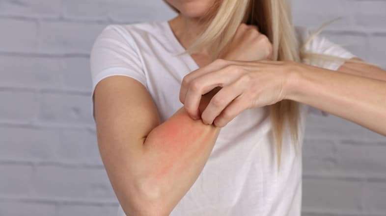 Psoriasis, remedios naturales para combatirla 1 Psoriasis, remedios naturales para combatirla